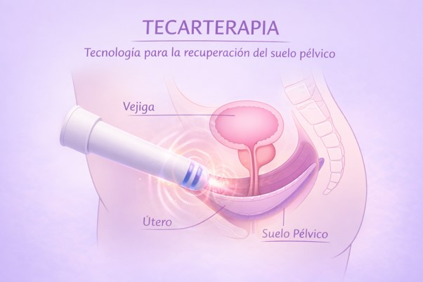 Tecarterapia en suelo pélvico